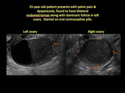 Imaging the endometrioma and mature cystic teratoma | MDedge ObGyn