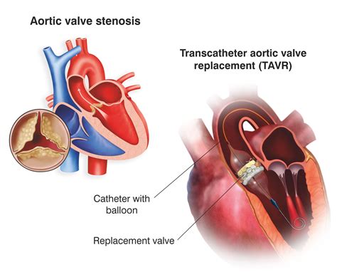 TAVR: Transcatheter Aortic Valve Replacement | Meril Life