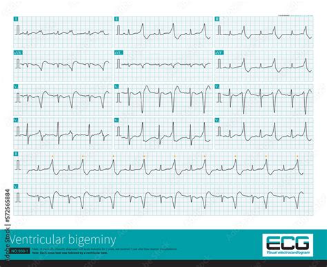 Some ventricular bigeminy are precursors of ventricular tachycardia, a ...