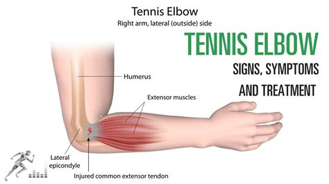 Tennis elbow: Signs and symptoms and treatment of the common elbow ...