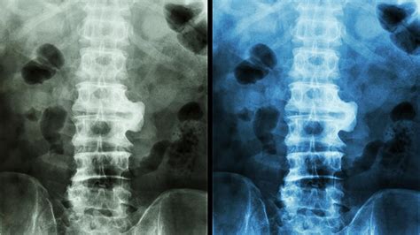 Ankylosing Spondylitis Remission | Everyday Health