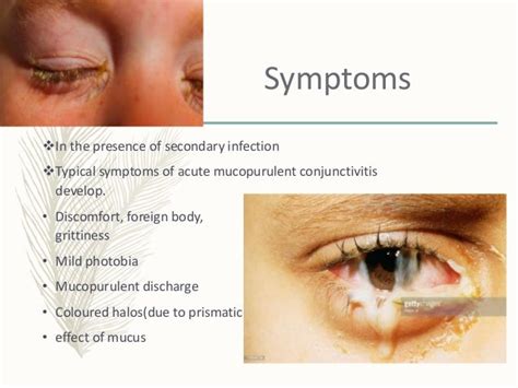 Trachoma