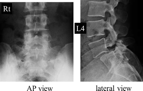 Successful Endoscopic Surgery for L5 Radiculopathy Caused by Far-Lateral Disc Herniation at L5 ...