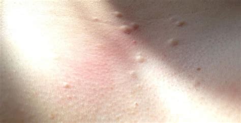 Small lumps under skin on chest – What are they? Can you please help? – Back/Body/Neck acne ...