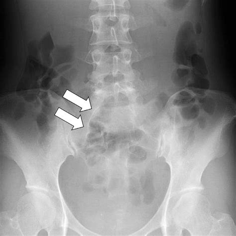 -Radiograph of the sacrum. The first sacral hiatus is asymmetrical, and... | Download Scientific ...