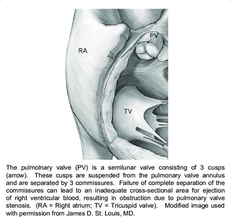 Pulmonary valve anatomy. | Download Scientific Diagram