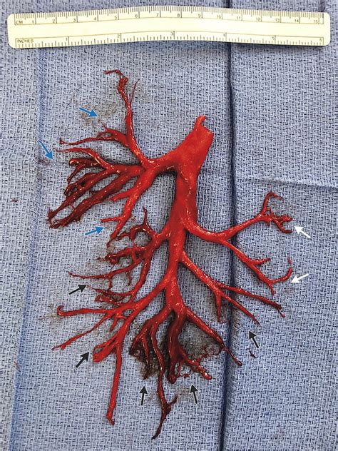 Shocking Blood Clot Takes on the Appearance of a Man's Lung