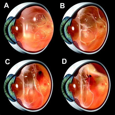 Management of retinal detachment: a guide for non-ophthalmologists ...