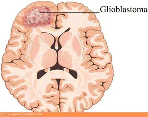 Glioblastoma –Symptoms, Causes, Diagnosis, And The best Treatment - Dr ...