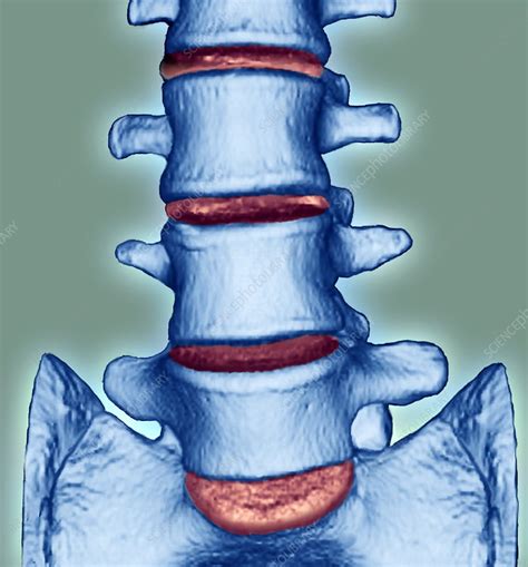 Spine disorder - Stock Image - M200/0206 - Science Photo Library