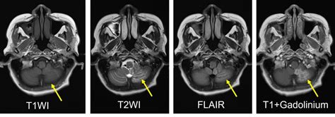 PICA infarction – Radiology Cases