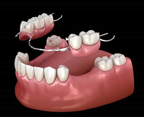 Partial Dentures - Permanent Teeth Replacement | Western Canada