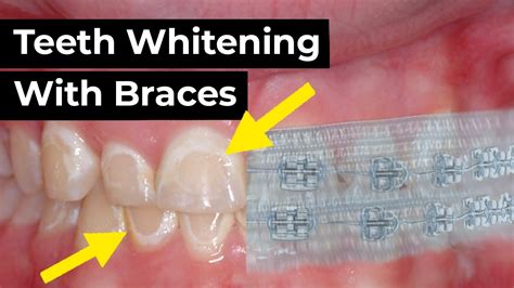 Teeth Whitening with Braces?! - YouTube