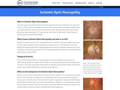 Ischemic Optic Neuropathy - Retina-Vitreous Surgeons of CNY