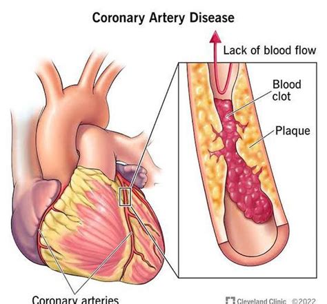 Coronary artery disease - MEDizzy