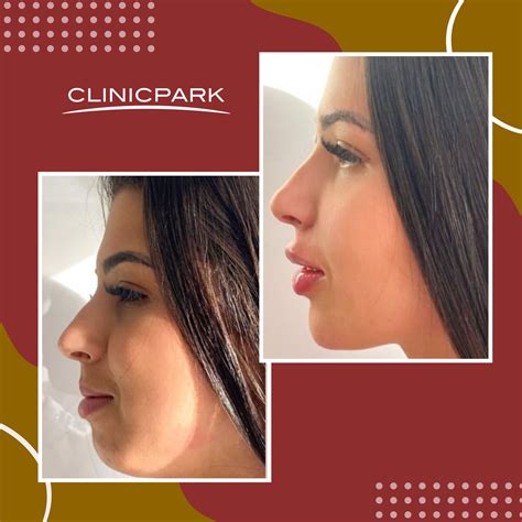 Face Plastic Surgery In Turkey - Clinicpark