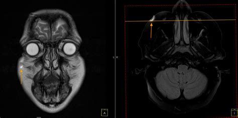 What is this bright spot on my MRI? : r/askneurology