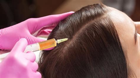 PRP capilar, el tratamiento con Plasma Rico en Plaquetas para regenerar tu cabello