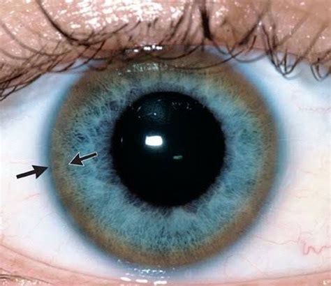 Kayser-Fleischer ring at the rim of cornea in a patient with - MEDizzy