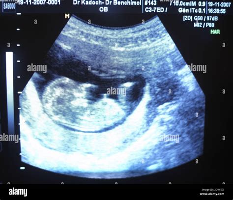 Ultrasound Scan for pregnancy on or near 12 weeks showing baby s head and legs Stock Photo - Alamy