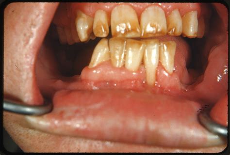 Fluorosis, dental; Mottled Enamel; Dental Fluorosis