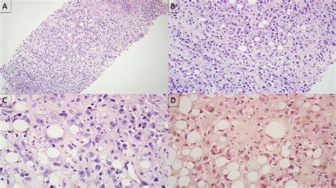 Supraclavicular nodal mass: a core biopsy revealed (a) discohesive... | Download Scientific Diagram