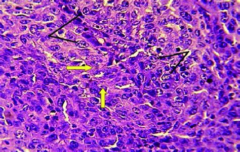 The histopathological section in the subcutaneous tissue of skin at the ...