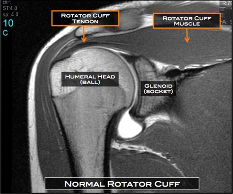 Shoulder Surgery Austin, TX | Rotator Cuff Repair Cedar Park | Round Rock