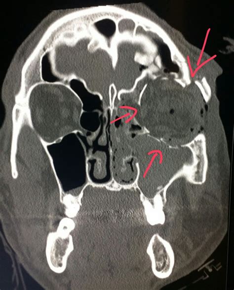 #Face #CT shows multiple #fractures of the #orbit in a #patient who was punched in the #eye. # ...