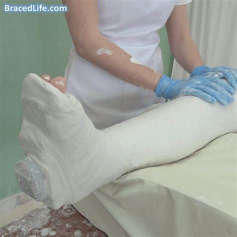 Smoothing out the plaster cast - BracedLife by MedicBrace on DeviantArt