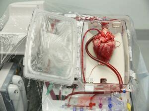 Heart Lung Transplant - Physiopedia