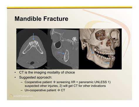 Imaging of Facial Trauma