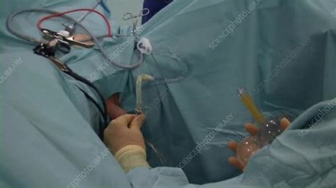 Bladder evacuation during a TURP biopsy - Stock Video Clip - K003/8584 - Science Photo Library