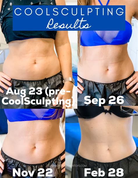 My CoolSculpting Results are in! - My Boys and Their Toys | Cool sculpting, Coolsculpting ...