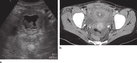 Hemorrhagic cystitis in a 26-year-old woman with acute lymphoblastic ...