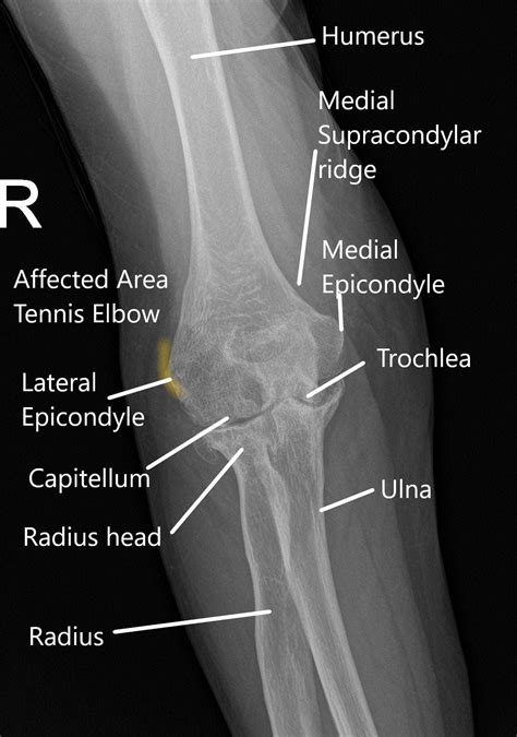 Tennis elbow-a pain in the elbow that we quickly solve for you! - Ad Sacrum