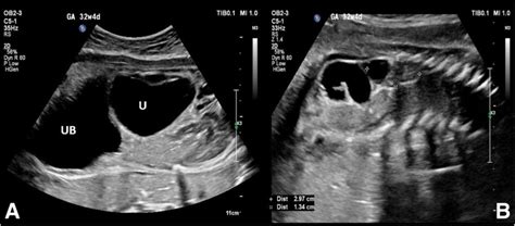 Challenging diagnosis of prune belly syndrome antenatally: a case ...