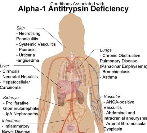 Alpha-1 Antitrypsin Deficiency