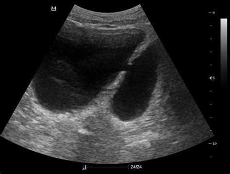 Bladder diverticulum | Radiology Case | Radiopaedia.org | Vesicula biliar, Vesicula, Abdomen