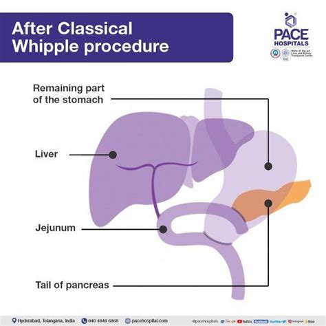 Best Hospital for Whipple Procedure in Hyderabad | Surgery and Cost