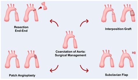 Diagnostics | Free Full-Text | Coarctation of the Aorta: Diagnosis and ...