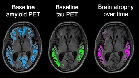 Alzheimer ‘Tau’ Protein Far Surpasses Amyloid in Predicting Toll on ...