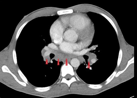 CT chest showing extensive hilar and mediastinal adenopathy (red arrow... | Download Scientific ...