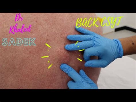 Large Back Cyst Removal by Dr Khaled Sadek - YouTube