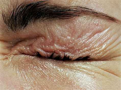 10 Blepharitis Symptoms to Know: Signs of This Bizarre Condition | SELF