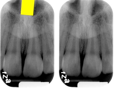 anterior nasal spine – Dr. G's Toothpix