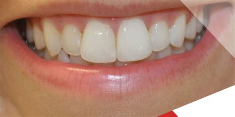 Why Do Front Teeth Look Big After Braces? Royal Dental Clinics Blog