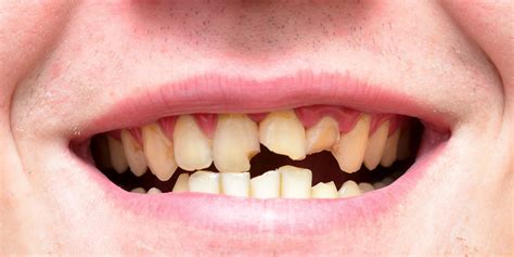 British People Are Becoming 'Internationally Renowned' For Having Bad Teeth - Here's How To Keep ...