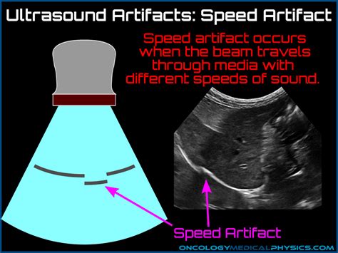 Ultrasound Artifacts | Oncology Medical Physics