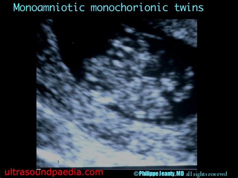 Monoamniotic twins – ULTRASOUNDPAEDIA